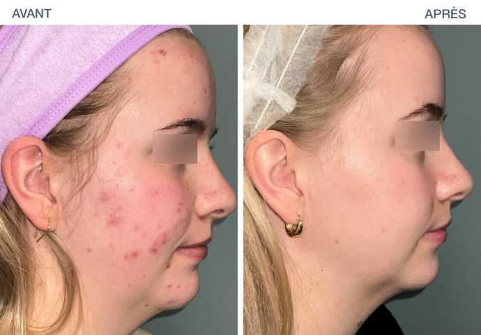 avant apres ultraclear 03