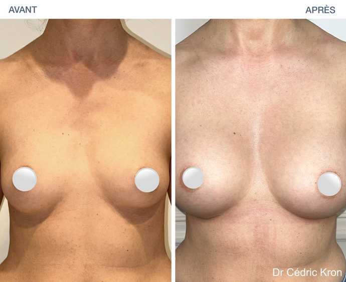 Augmentation mammaire avec implants Ergonomix 2 (femme de 38 ans)