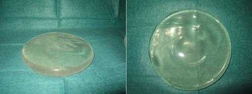 Round shaped breast implant