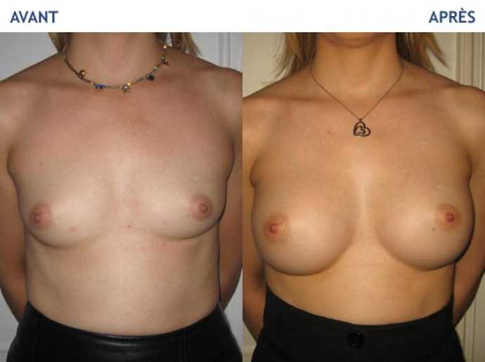 Avant - Après d'une chirurgie esthétique des seins avec prothéses mammaires