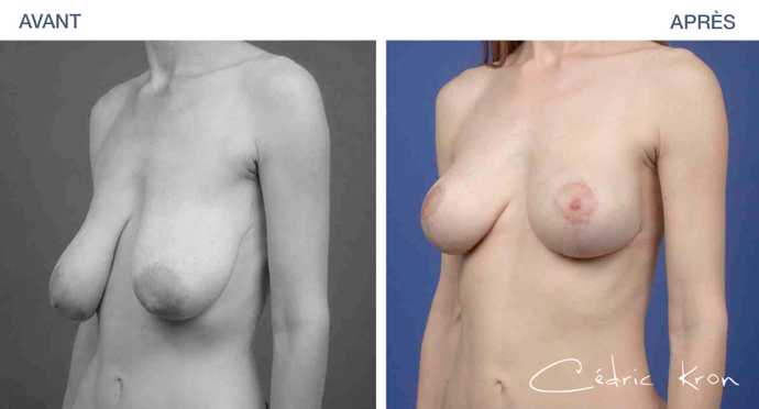 Avant - Après d'une chirurgie de correction de ptôse mammaire (vue de 3/4)