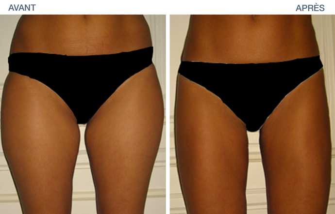 Before and after : result of a liposuction of the thighs