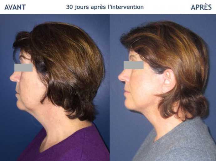 Avant - Après Lifting cervico-facial