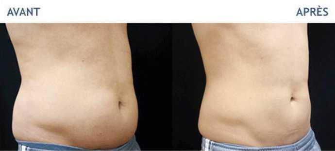 Before & After pictures of Cryolipolyse with Coolsculpting treatment