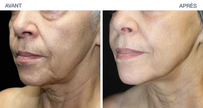 avant apres ultraclear 04