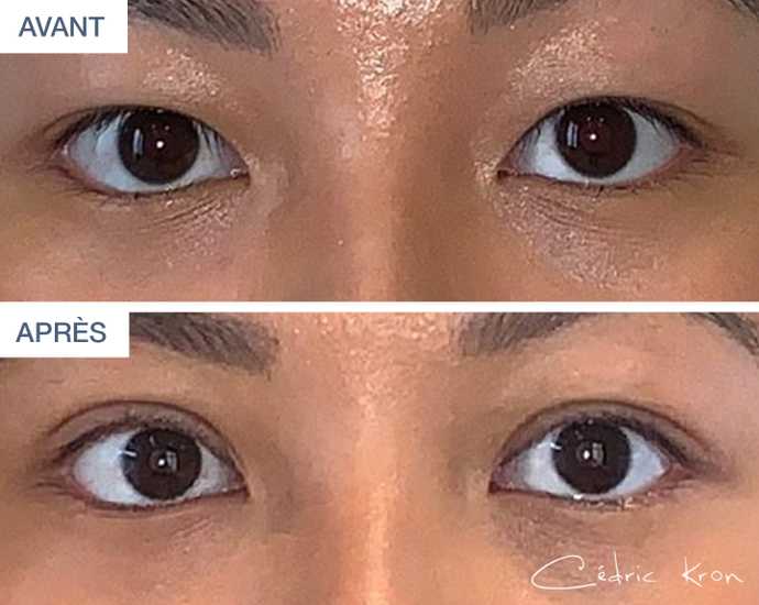 Résultat d'une blépharoplastie asiatique réalisée sur une jeune femme de 20 ans