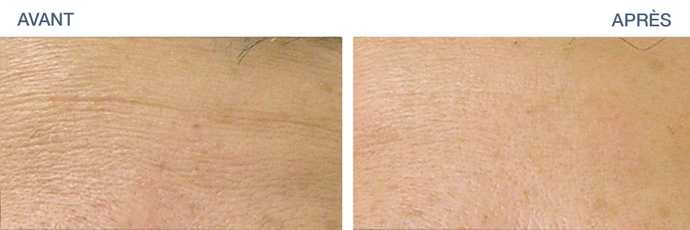 Before - After: HydraFacial treatment of the horizontal lines of the forehead