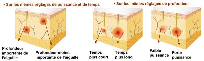 Radio-Frequency Device Settings Used in Skin Treatments with Keybody-Lipo