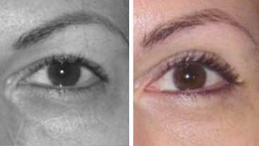 Before & After: Blepharoplasty - Eyelid surgery