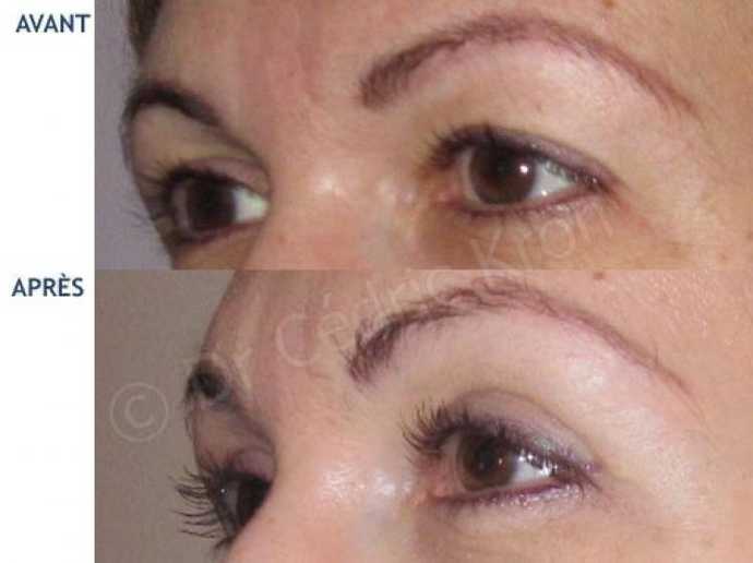 Before & after photos of blepharoplasty, eyelid surgical procedure