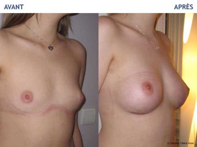 Before - After breast augmentation using implants