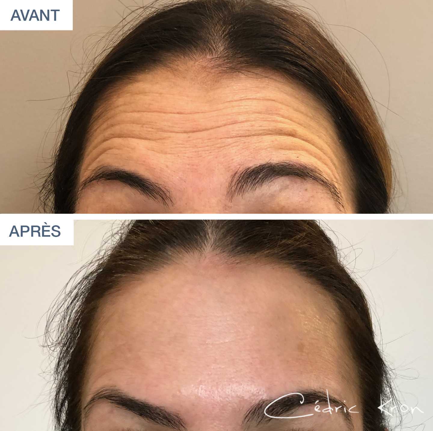 Avant-Après : Traitement des rides du front par botox