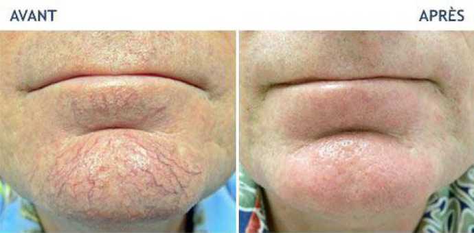 Before and after photos of a laser treatment of 