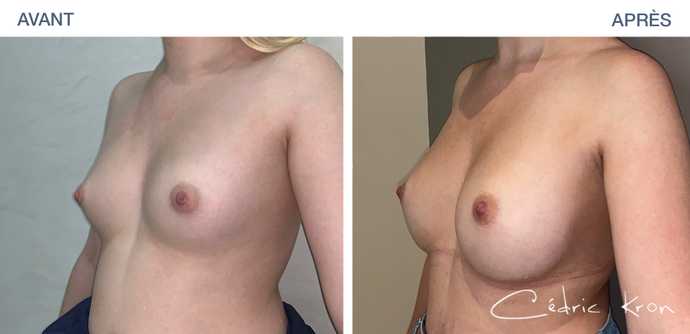 Augmentation mammaire avec des implants Ergonomix en photo avant-après