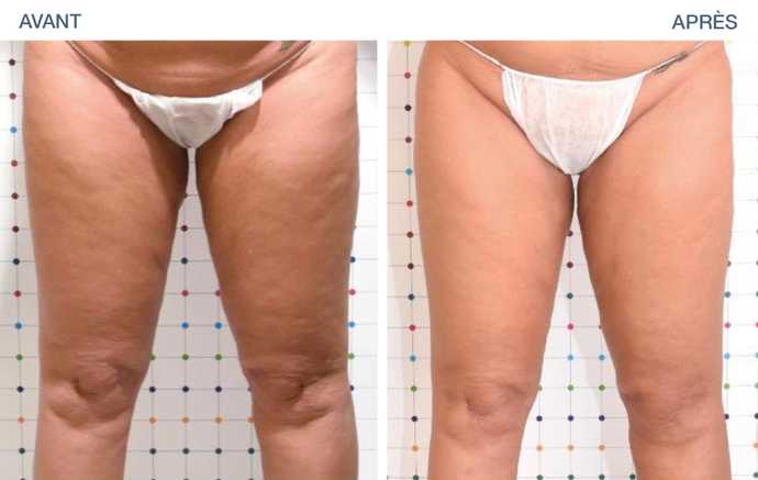 Traitement de la cellulite des cuisses et des genoux