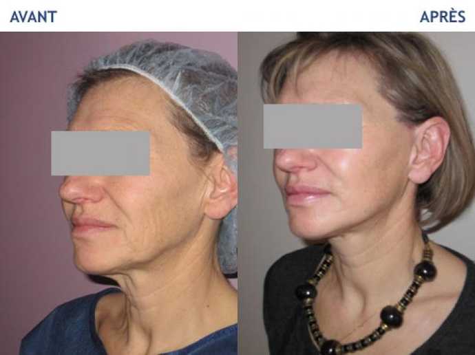 Avant - Après Lifting facial