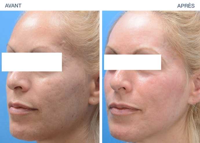 Avant - après : cicatrices d'acné supprimées par radiofréquence