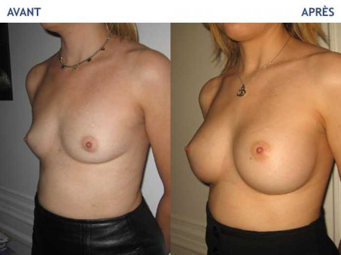Avant - Après d'une chirurgie esthétique des seins avec prothéses mammaires