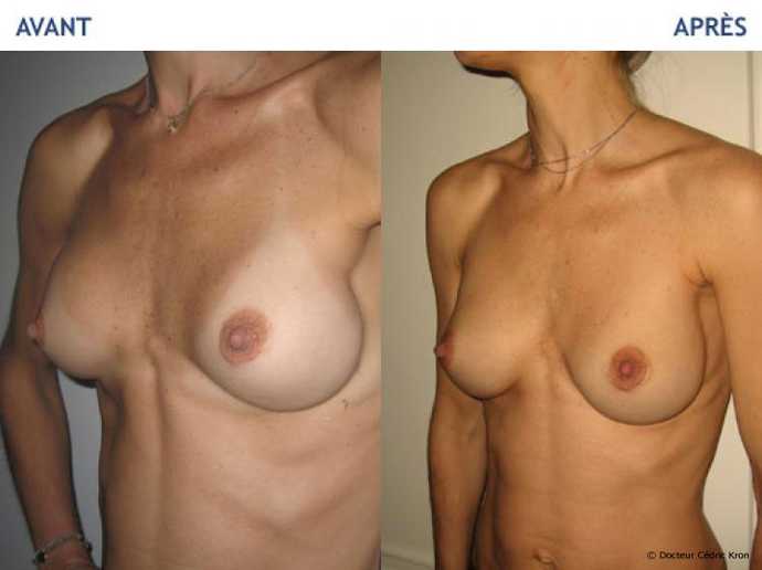 Before - After breast augmentation using implants