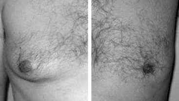 Before & After: Men's Gynecomastia and Adipomastia
