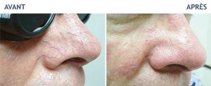 Before and after photos of a laser treatment of skin wrinkles
