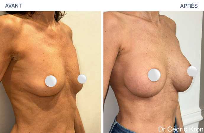 Avant - Après : Augmentation mammaire avec implants Ergonomix 2 (femme de 52 ans)