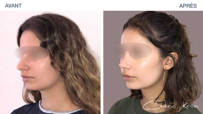 Résultat d'une rhinoplastie, une chirurgie esthétique du nez en photo avant - après