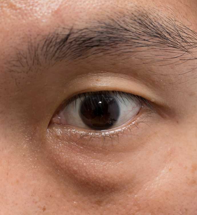 Les cernes pleins (ou poches sous les yeux) sont causés par le relâchement des tissus