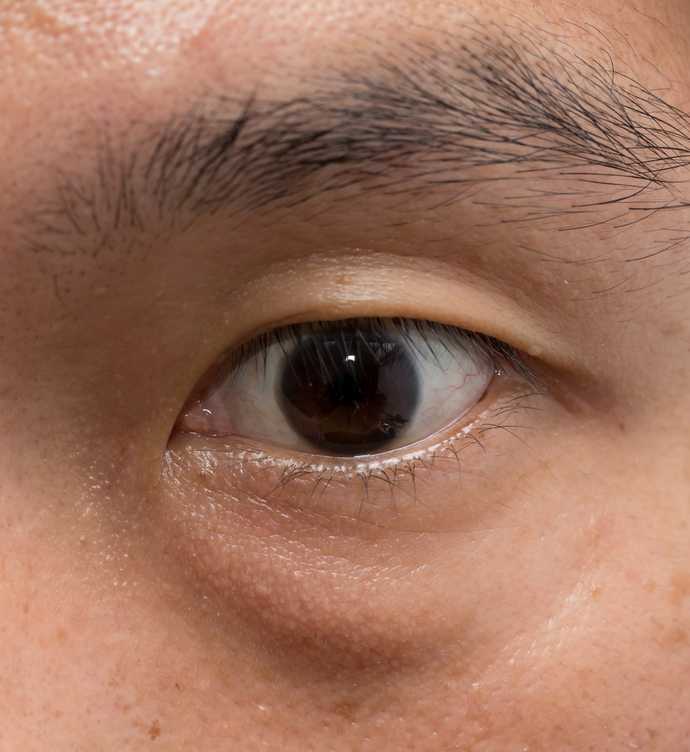 Corriger les cernes opleins par blépharoplastie inférieure