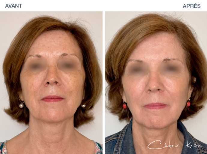 Avant - Après : Traitement des tâches pigmentaires du visage d'une femme d'une cinquantaine d'année ans avec le laser Ultraclear