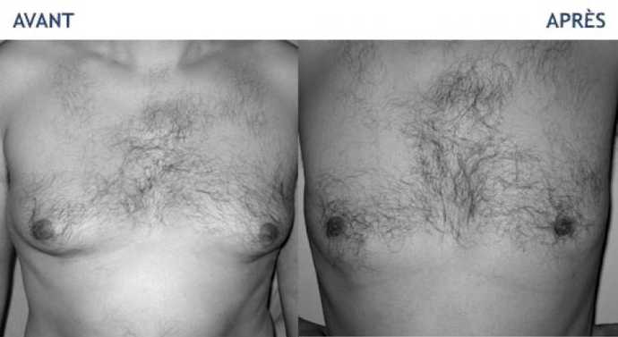 Before and after of a treatment of Men's Gynecomastia and adipomastia)