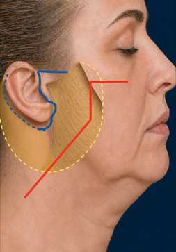Diagram of an LVPA-type deep plane facelift: SMAS incision