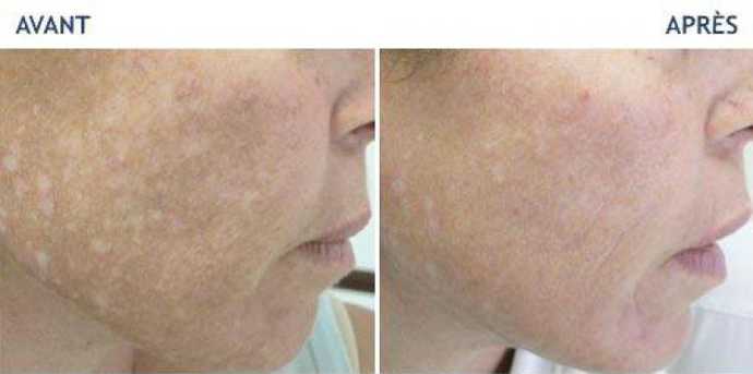Before and after photos of a laser treatment of pigment spots