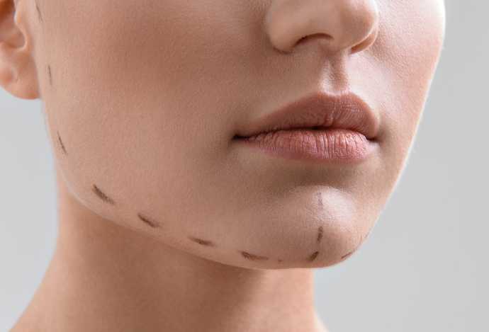 The deep plane facelift procedure