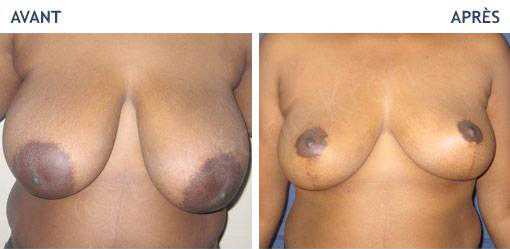 Before & after photo of breast reduction to correct breast hypertrophy
